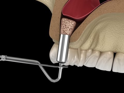 Sinus Lift Surgery Barry Heaton DDS Houston Dental Implants